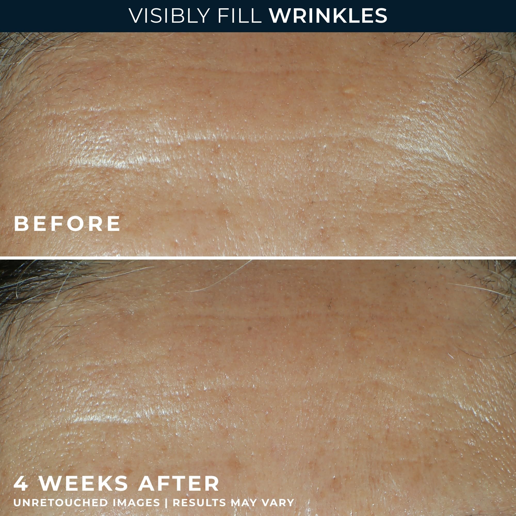 RoC Retinol Correxion Wrinkle Filler for Deep Wrinkles with Hyaluronic Acid & Retinol, Skin Care for Women and Men, 1 Fl Oz (Packaging May Vary)