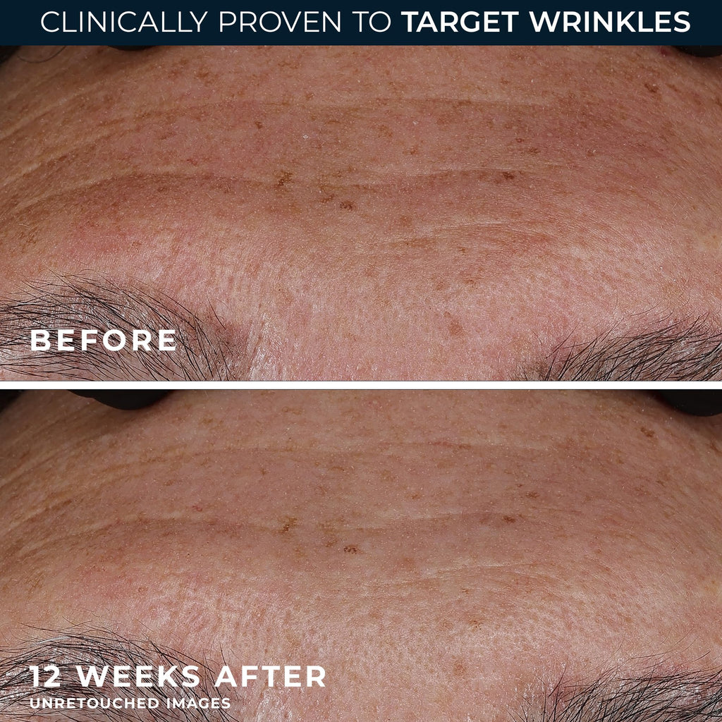 RoC Retinol Correxion Wrinkle Filler for Deep Wrinkles with Hyaluronic Acid & Retinol, Skin Care for Women and Men, 1 Fl Oz (Packaging May Vary)