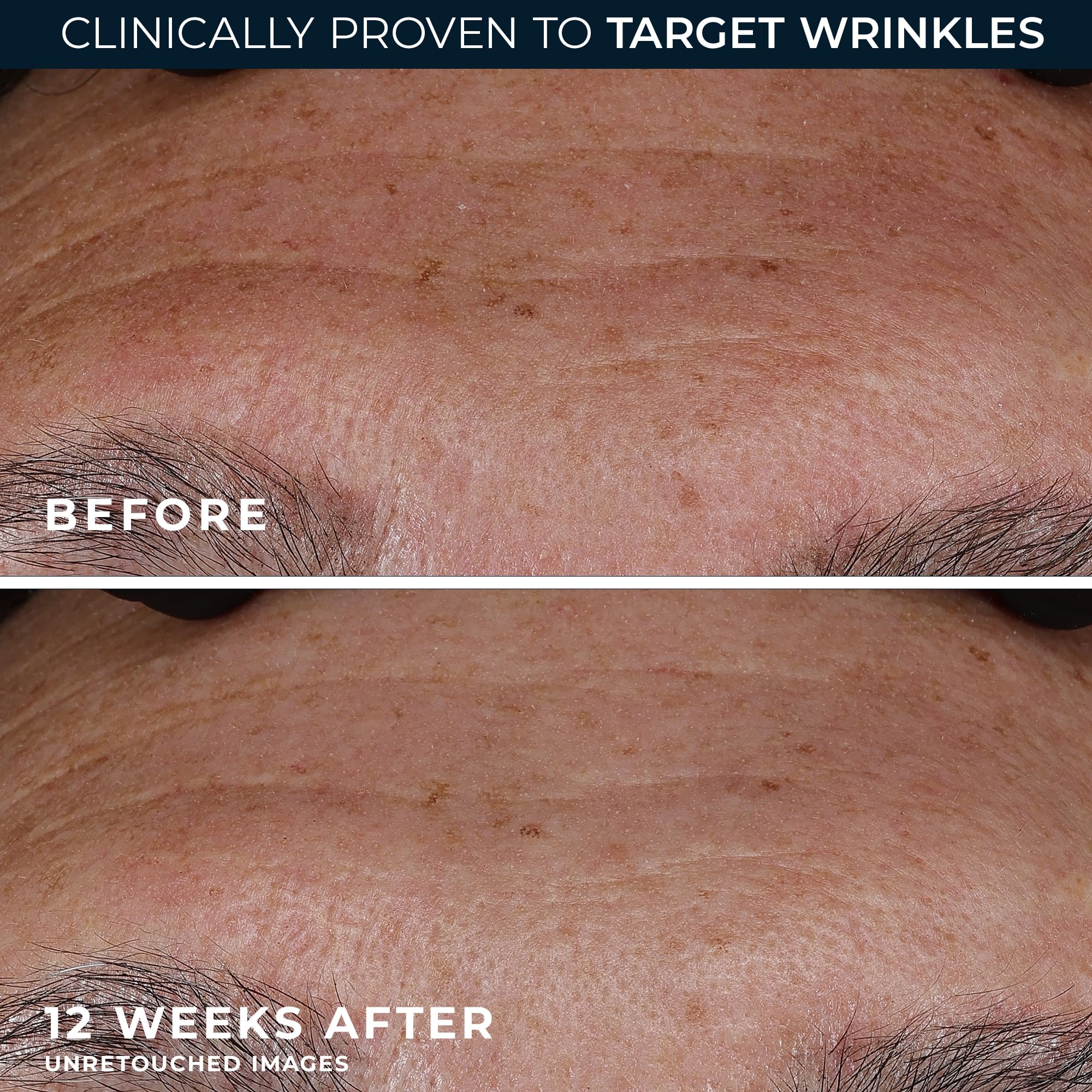 RoC Retinol Correxion Wrinkle Filler for Deep Wrinkles with Hyaluronic Acid & Retinol, Skin Care for Women and Men, 1 Fl Oz (Packaging May Vary)